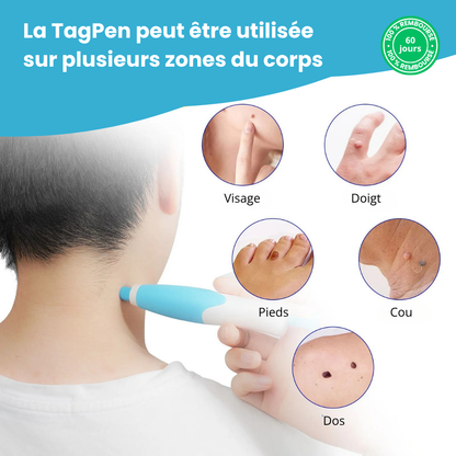 Kit TagPen™ | Retirez vos acrochordons facilement, en toute sécurité, à la maison | -50 %