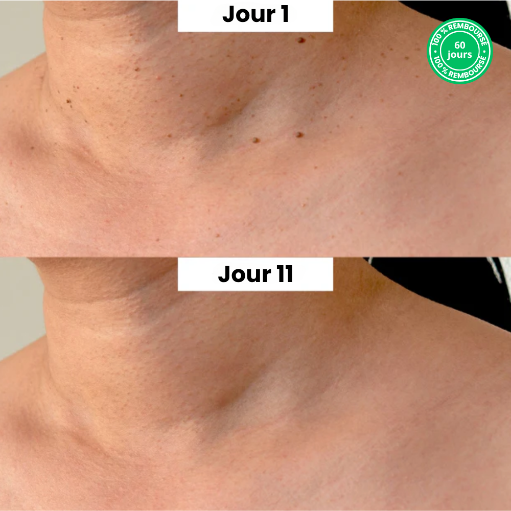 Kit TagPen™ | Retirez vos acrochordons facilement, en toute sécurité, à la maison | -50 %