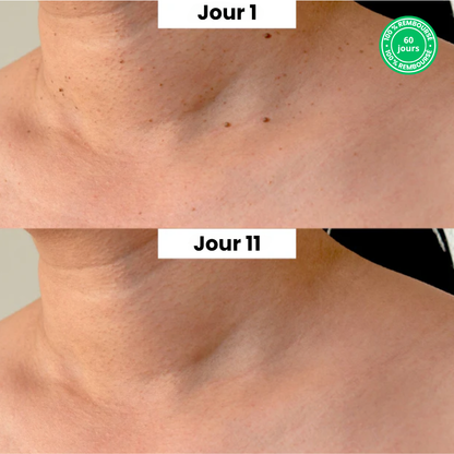 Kit TagPen™ | Retirez vos acrochordons facilement, en toute sécurité, à la maison | -50 %