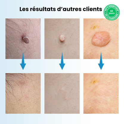 Kit TagPen™ | Retirez vos acrochordons facilement, en toute sécurité, à la maison | -50 %